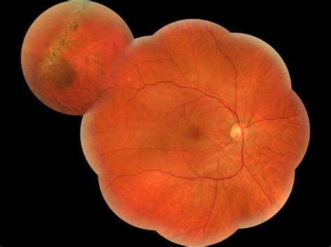 Lattice Degeneration and Choroidal Nevus - Retina Image Bank