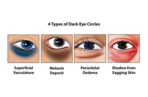 Dark Eye Circles Removal Singapore - Harmony Aesthetics Clinic