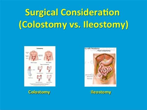 Colostomy complications