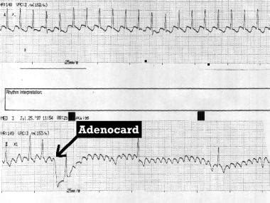 What is the role of vagal maneuvers in the diagnosis of atrial flutter ...