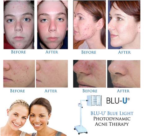 Orleans Dermatology and Laser Therapies - Photodynamic Therapy & BLU-light