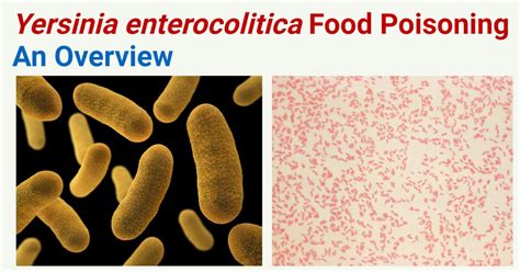 Yersinia enterocolitica Food Poisoning (Yersiniosis)