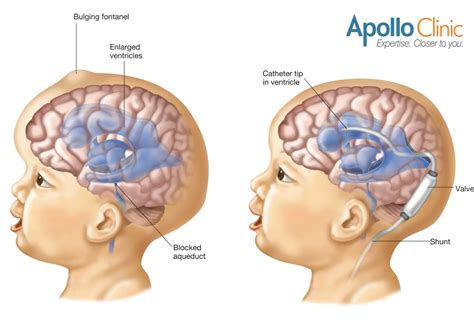 Hydrocephalus: A Neurological Condition and its Treatments | Apollo Clinic