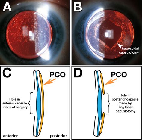 Posterior capsular opacification following intraocular lens implant ...