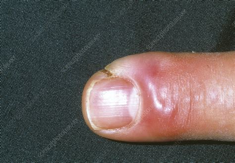 Cellulitis Finger