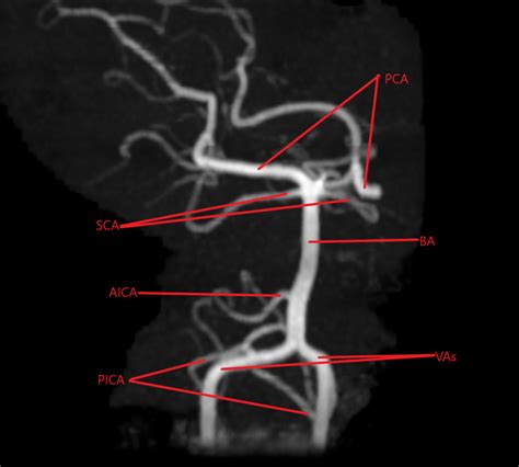 [Figure, Magnetic Resonance Angiogram of the...] - StatPearls - NCBI ...