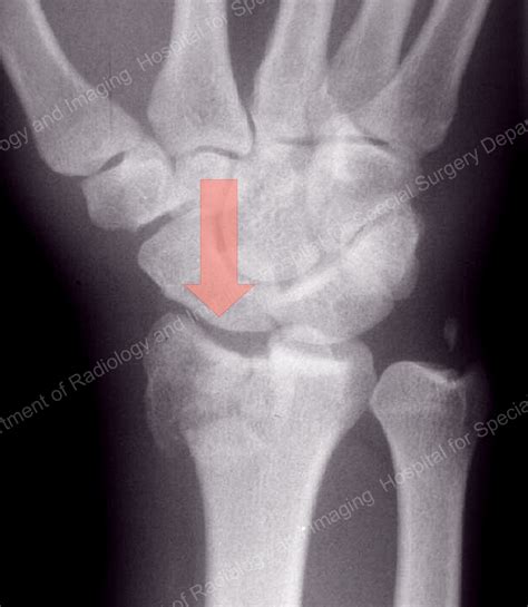 Avoiding Distal Radius Fracture Complications (Broken Wrist) (2023)