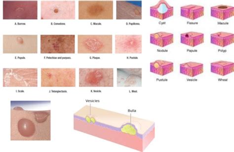 Macule Vs Papule