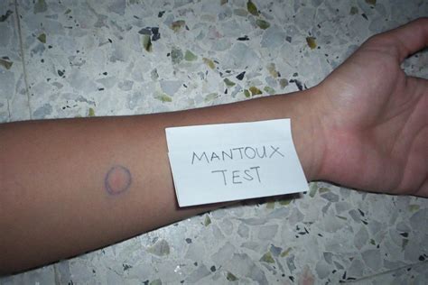 Between the Lines: MANTOUX Test