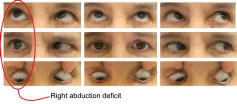 Sixth nerve palsy – Case-Based Neuro-Ophthalmology