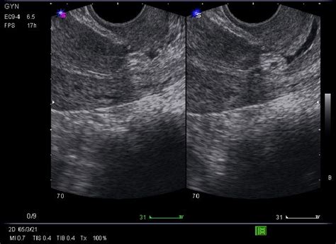 WK 3 L 2 Cervical polyp | uterus