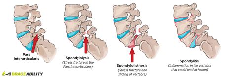 Spondylolysis & Spondylolisthesis Treatment Back Brace