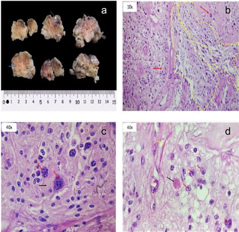 Pleomorphic Xanthoastrocytoma Presenting as Long-Term Complex Focal ...