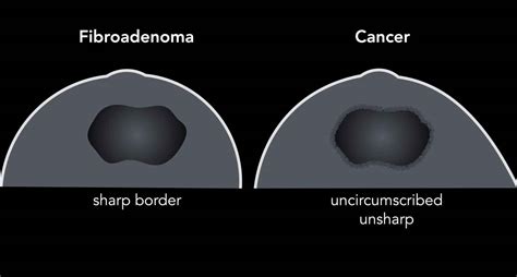 Breast Cyst Ultrasound