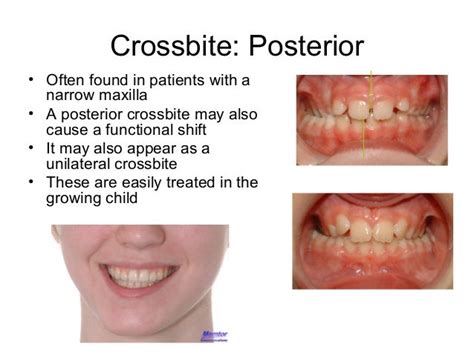 Gallery Unilateral Posterior Crossbite