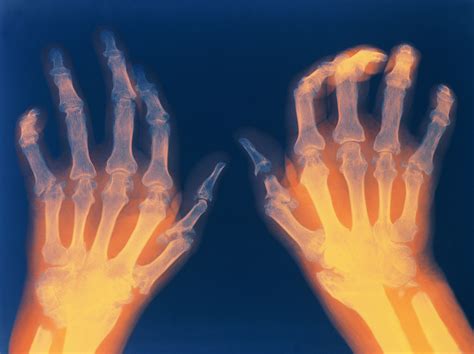 How Rheumatoid Arthritis Affects Each Part of the Body