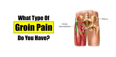 What Kind of Groin Pain Do You Have? – Squat University