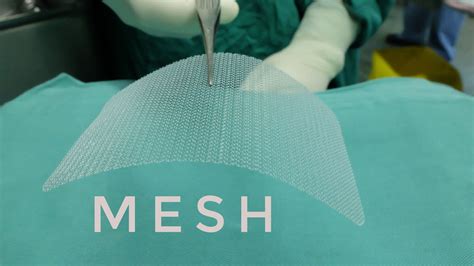 Hernia Mesh Lawsuits | How a Hernia Mesh Injury Attorneys Can Help You