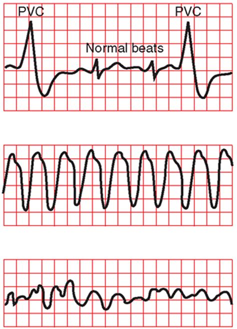 Understanding Abnormal ECG Tracings with Dr. Philip Judge