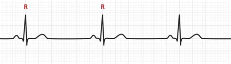 Sinus Bradycardia | Bradyarrhythmias - MedSchool