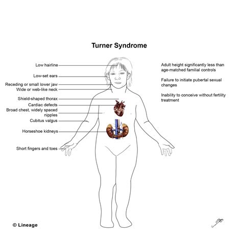 Turner Syndrome - Pediatrics - Medbullets Step 2/3