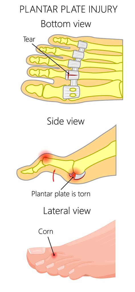 Plantar Plate Injuries - Physiopedia