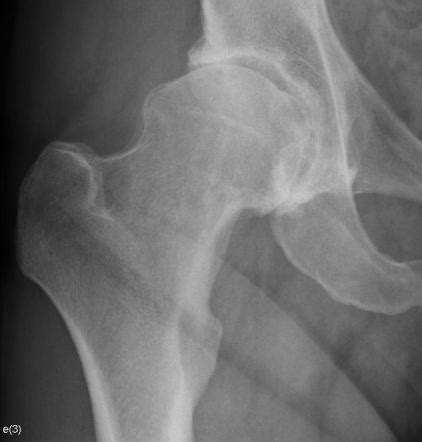 Osteoarthritis of the hip | Radiology Reference Article | Radiopaedia.org