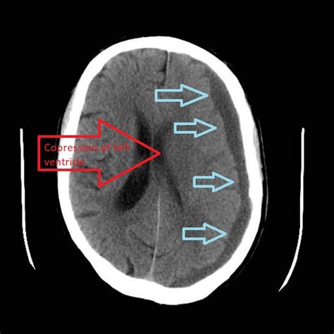 Subdural Hematoma Ct Head