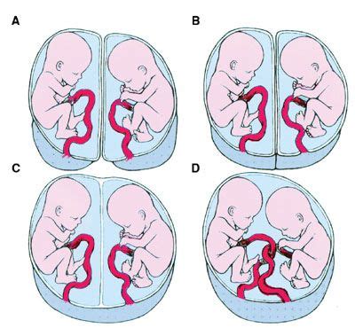 Identical Twins Placenta