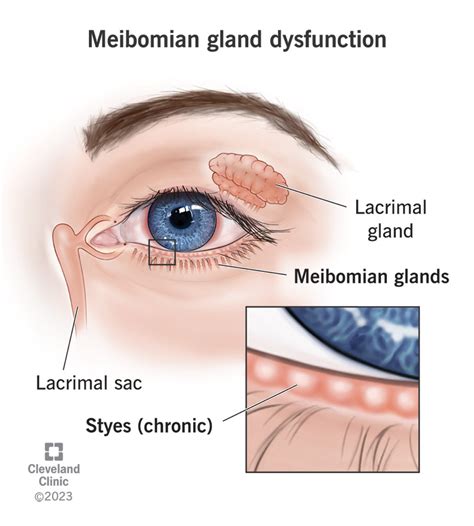 Meibomian Gland Dysfunction: Symptoms & Treatment