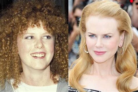 Nicole Kidman and her plastic surgery procedures