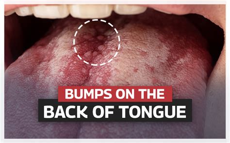 Bumps On The Back Of The Tongue | Causes, Treatment & Prevention