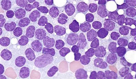 Chronic Lymphocytic Leukemia - 2.