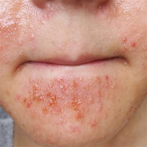 Common Skin Disease - True Clinic