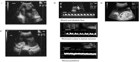 Monochorionic diamniotic twins: complications and management ...