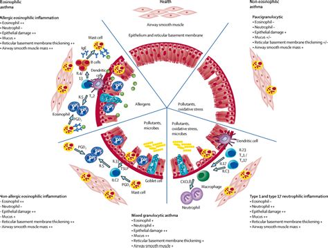 Asthma - The Lancet