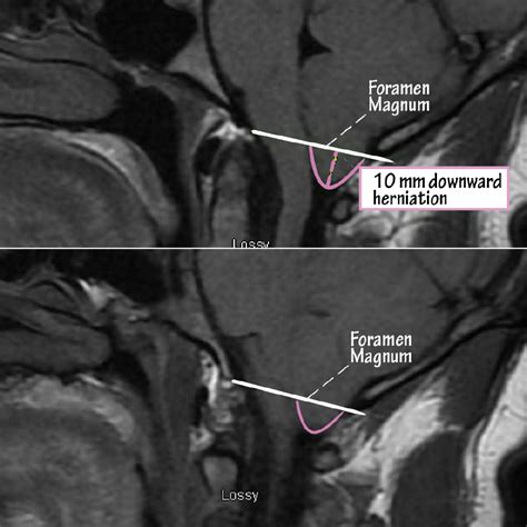 Foramen Magnum Mri