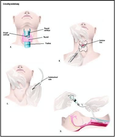 Cricothyroidotomy Anatomy