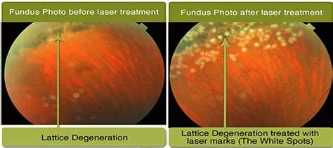 Lattice Degeneration & Retinal Detachment Risk - Preventative Treatment ...