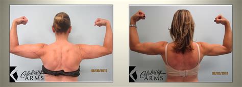 Revolutionary Upper Arm Liposuction & Sculpting - Celebrity Arms