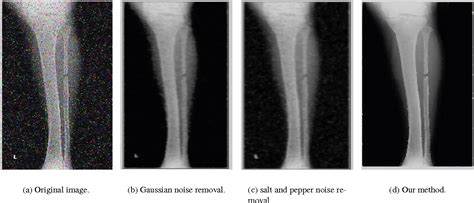 Figure 6 from Determining the Type of Long Bone Fractures in X-Ray ...