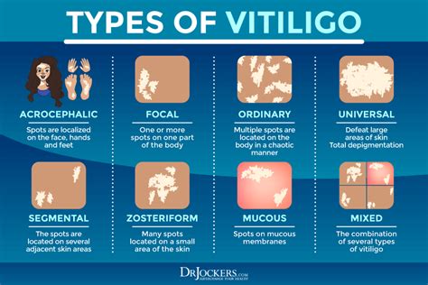 Vitiligo: Symptoms, Causes, and Support Strategies - DrJockers.com