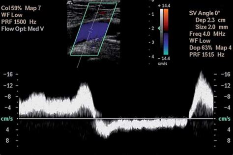 Venous Duplex Ultrasound with Distal Augmentation | Naples Cardiac ...