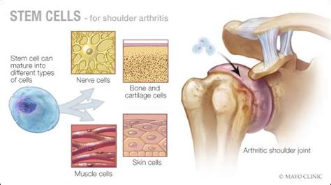 Mayo Clinic Q and A: Stem cell therapy for arthritis - Mayo Clinic News ...