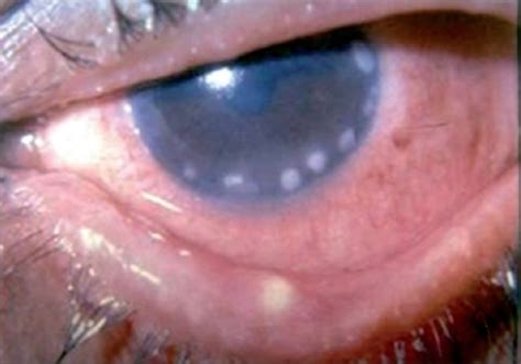 Keratitis - Causes, Symptoms, Diagnosis, Prevention, Treatment