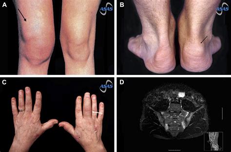 Arthritis Of Inflammatory Bowel Disease - Captions Blog