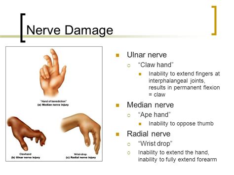 Claw Hand, or 'Spinster's Claw #medical article #anatomy - LANKA STUDENTS