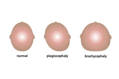 Flat head syndrome (plagiocephaly and brachycephaly) - Health Under 5s