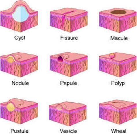 SKIN LESION: Cyst, Fissure, Macule, Nodule, Papule, Polyp, Pustule ...