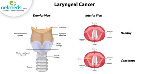 Laryngeal Cancer: Causes, Symptoms And Treatment